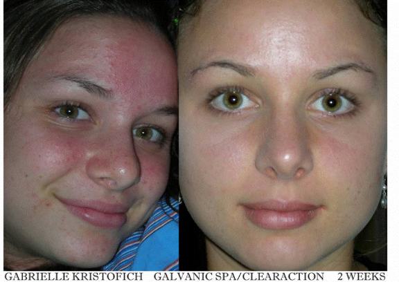 Acne Skin Care Products, Best Acne Treatment Acne Skin Care Products, Best Acne Treatment