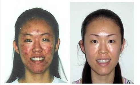 Acne Skin Care Products, Best Acne Treatment Acne Skin Care Products, Best Acne Treatment