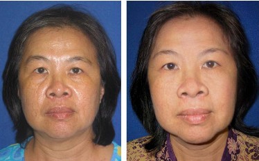 Lady before and after  Anti Aging Creams