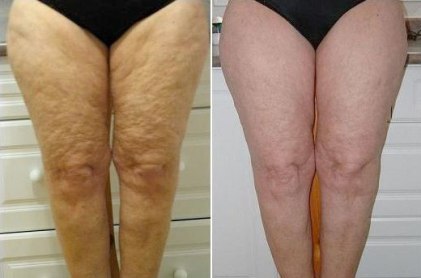 cellulite on legs before and after Anti Aging Treatments