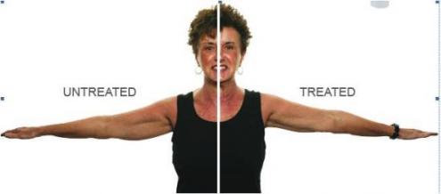 cellulite on arms before and after Anti Aging Treaments cellulite on arms before and after Anti Aging Treaments